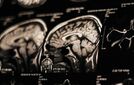 Suomalaislöytö: Tällaisia ongelmia Alzheimeria sairastavilla oli jopa vuosia ennen diagnoosia